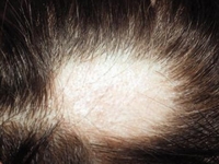 اكتشاف الجين المسؤول عن تساقط الشعر وداء الثعلبة
