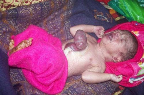 طفل هندي يولد بقلب بارز من صدره