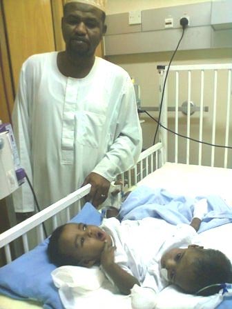 عملية فصل التوأم السوداني غدا ستستغرق 17 ساعة