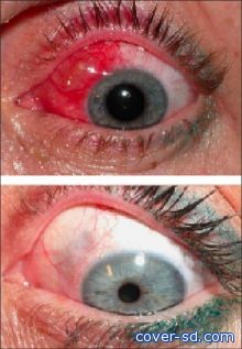 العين الحمراء.. التهاب الملتحمة يصيب ألف شخص بالجزيرة